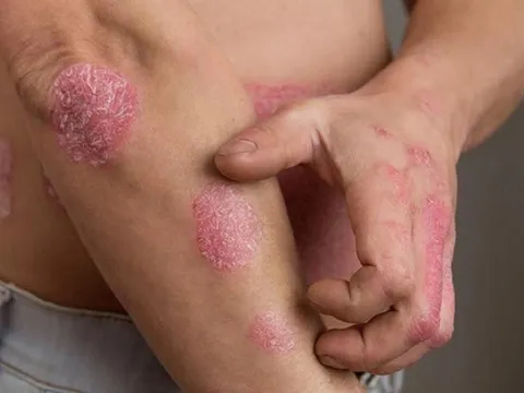 Cách chữa bệnh vảy nến lâu năm