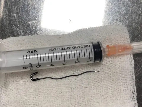 Nuốt phải kim băng, bé trai 2 tuổi suýt thủng ruột