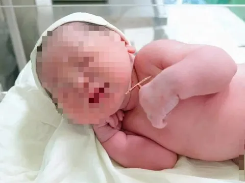 Hi hữu bé gái chào đời mang theo vòng tránh thai của mẹ