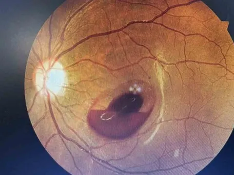 Bị tia laser ở quán bar chiếu vào mắt, cô gái 18 tuổi đối diện nguy cơ mất thị lực