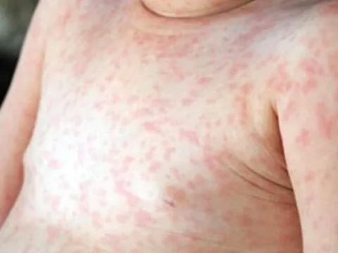 Quảng Nam thông tin về 43 trẻ sốt phát ban, 3 trường hợp tử vong trong dịp Tết