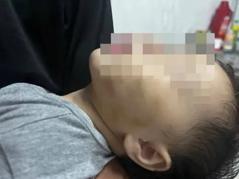 Thông tin mới nhất vụ bé gái gần 9 tháng tuổi bị bầm trên má tại điểm trông trẻ tự phát