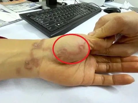 Đi ngoài hơn 20 lần một ngày, người phụ nữ đi viện mới biết sán bò lổm ngổm dưới da