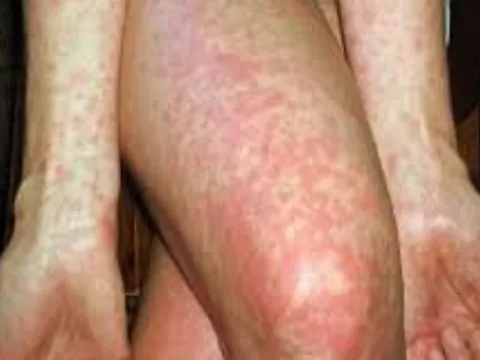 Sốt cao, phát ban đỏ vì mắc bệnh truyền nhiễm nguy hiểm hay gặp mùa đông xuân