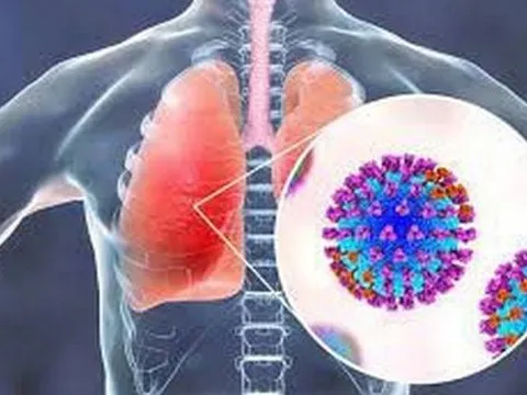 Chưa quan tâm đúng mức đến bệnh nấm phổi