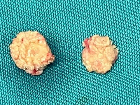 Sưng đau vùng hàm, đi khám phát hiện bị sỏi tuyến nước bọt