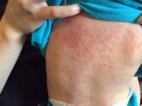 Bài học phòng lây nhiễm chéo từ dịch sởi năm 2014