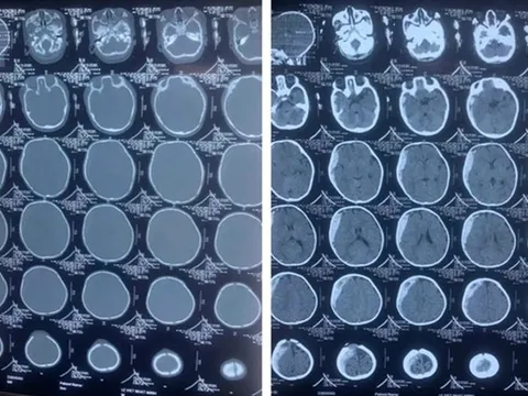 Bé 11 tháng tuổi bỗng thét lên 1 tiếng lớn rồi hôn mê, bố mẹ khóc nghẹn khi biết nguyên nhân
