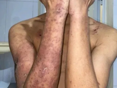Đắp kiến ba khoang chữa ngứa, nam thanh niên gánh hậu quả