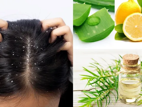 TOP dầu gội trị gàu mượt tóc, trị nấm da đầu hiệu quả nhất