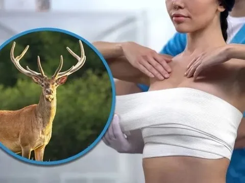 Bị biến dạng vòng 1 sau khi chi 8,4 tỷ đồng nâng ngực, cô gái sốc nặng khi phát hiện sự thật đáng sợ