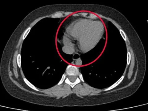 Sau khi bị đau bụng, nôn ói, bé gái 9 tuổi phải cắt bỏ 1 bên buồng trứng