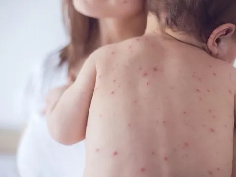 Bộ Y tế khuyến cáo sau ca bệnh người lớn đầu tiên tử vong vì bệnh sởi