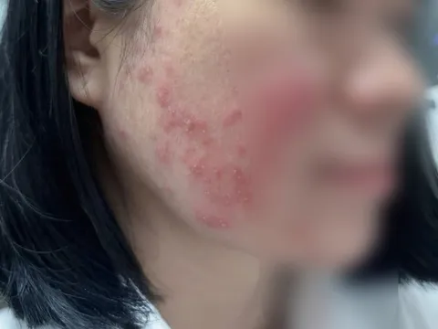 Tin kem trị mụn "thiên nhiên" trên TikTok, nữ sinh Hà Nội phải cầu cứu bác sĩ
