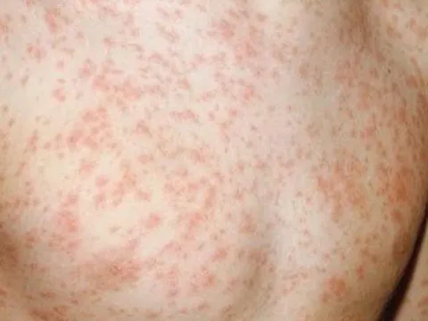 Ghi nhận 2 ca tử vong liên quan đến sởi