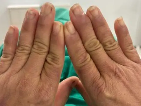 Người phụ nữ đau đớn mỗi khi chạm tay vào nước, đi khám ngỡ ngàng khi nhận kết quả
