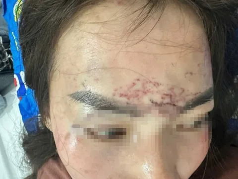 Điều tra vụ người phụ nữ đi đường bất ngờ bị kéo lên ô tô, "hành hạ" bằng axit và máy xăm