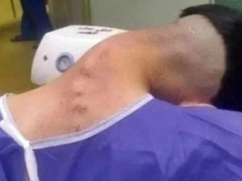 Thường xuyên làm việc này, chàng trai 23 tuổi mắc "hội chứng đầu gục"