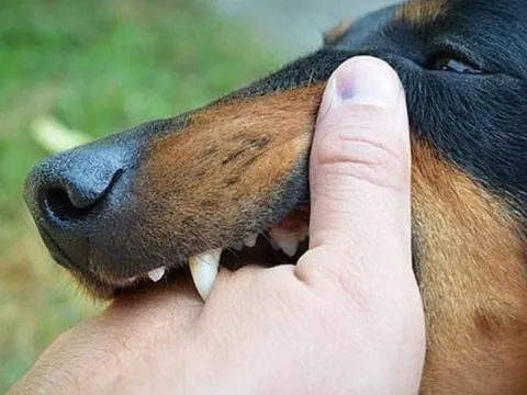 Bé trai 13 tuổi nguy kịch sau 2 tháng bị chó cắn vì sai lầm này của người thân