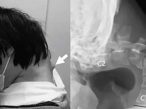 Nam thanh niên 25 tuổi không thể ngẩng đầu vì thói quen nhiều người trẻ mắc phải