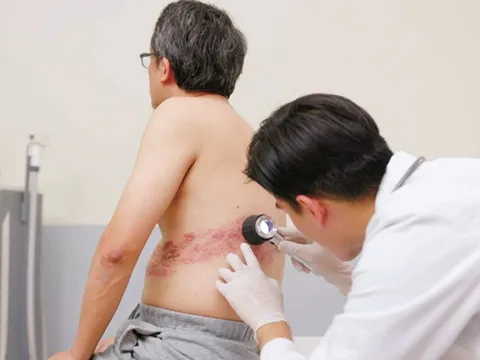 Zona thần kinh ở người cao tuổi