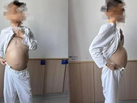 Người đàn ông 40 tuổi bụng to như mang bầu, khi phẫu thuật bác sĩ phát hiện điều đáng sợ