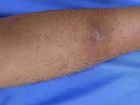 Sán 20 cm "đục lỗ" trên cơ thể người đàn ông có thói quen ăn đồ sống