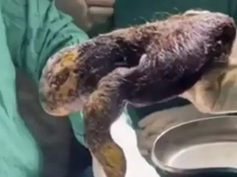 Bé gái 14 tuổi đau bụng, nôn mửa suốt 1 tháng, khi phẫu thuật bác sĩ lấy ra thứ không ngờ