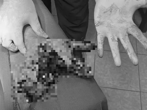 Người đàn ông 42 bị dập nát bàn tay vì thói quen khó bỏ