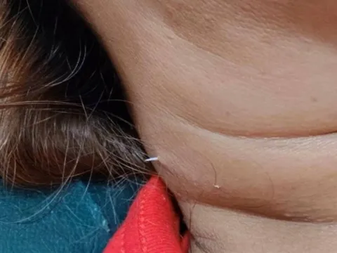 Đau cổ, người phụ nữ sốc nặng khi thấy thứ nhô ra ngoài