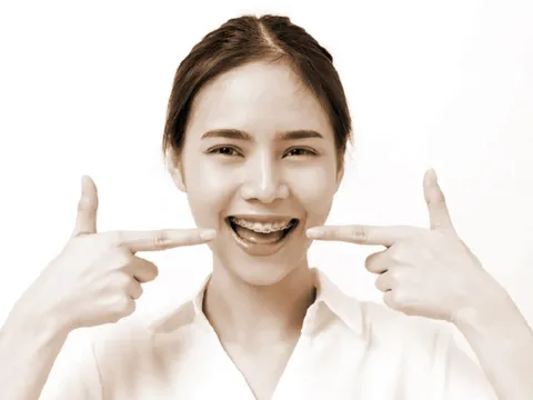 Niềng răng và lưu ý chăm sóc răng miệng