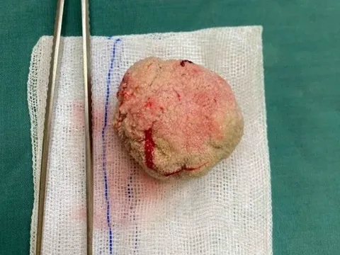 Cụ ông 98 tuổi có sỏi bàng quang "khủng" như quả trứng gà