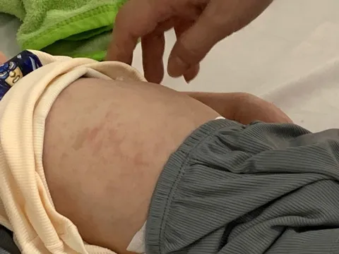 Rà soát đối tượng tiêm vaccine sởi