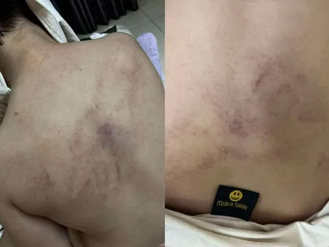 Hà Nội yêu cầu xác minh việc trẻ mầm non nghi bị giáo viên bạo hành