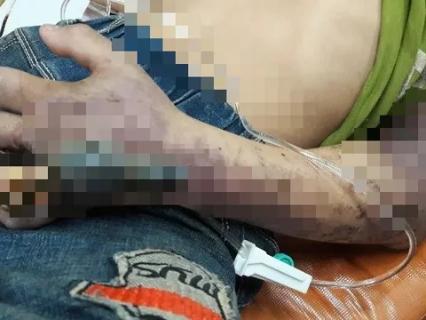 Bị rắn độc cắn, người đàn ông 50 tuổi tin thầy lang đắp thuốc lá "rước họa vào thân"