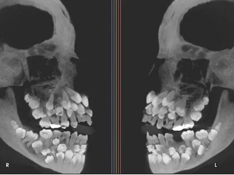 Đi nhổ răng sữa, bé gái khiến nha sĩ sốc nặng khi có 81 chiếc răng