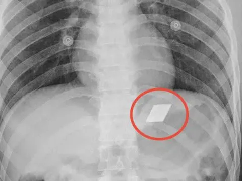 Khám cho nam thanh niên 26 tuổi, bác sĩ phát hiện thứ không ai ngờ