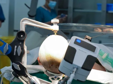 Vinmec tiên phong điều trị động kinh bằng Robot định vị thần kinh hàng đầu thế giới