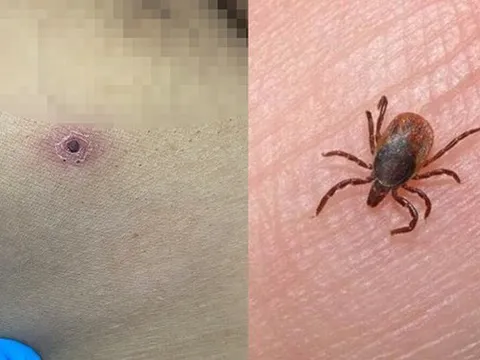 Chủ quan vết thương "lạ" trên cơ thể, người đàn ông 46 tuổi bị tổn thương gan, phổi