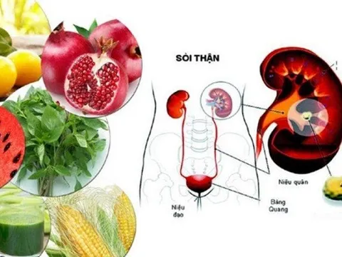 Bệnh nhân sỏi thận nên ăn gì?