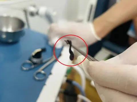 Đau mũi đi khám, bác sĩ sốc nặng khi thấy thứ trong mũi bé trai