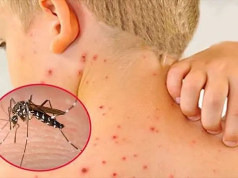 Sốt xuất huyết tăng “nóng” giữa mùa mưa, WHO khuyến nghị tiêm vắc-xin