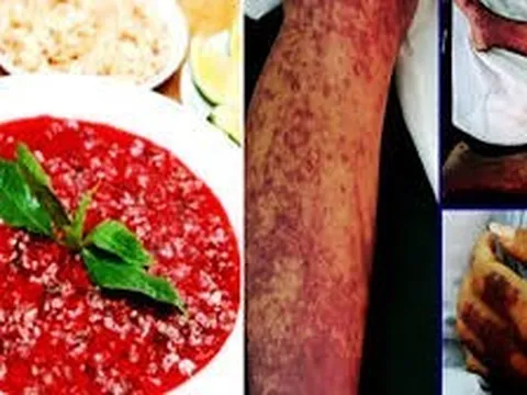 Ghi nhận các ca nhiễm bệnh liên cầu lợn gia tăng