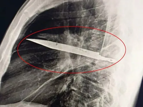 Người đàn ông bị chảy mủ dưới núm vú, bác sĩ phát hiện bí mật đáng sợ