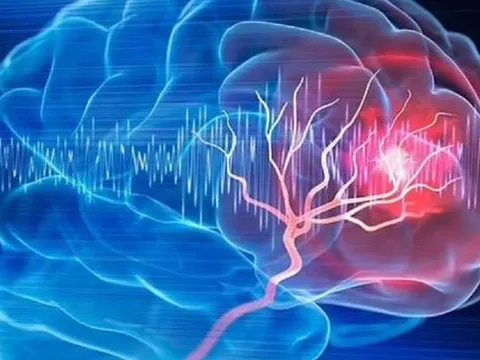 Người phụ nữ 57 tuổi bất ngờ phát hiện khối u não nhờ đồng hồ đeo tay