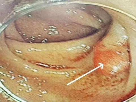 Bất ngờ "thủ phạm" khiến người phụ nữ 58 tuổi đau bụng kéo dài