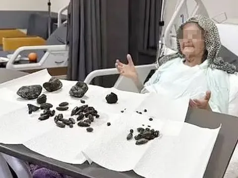 Khám bụng cụ bà 92 tuổi, bác sĩ sốc nặng khi thấy thứ bên trong