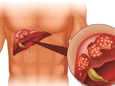 Nguy cơ viêm gan C