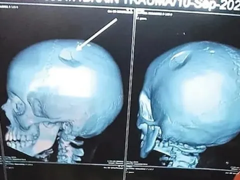 Con gái kêu đau đầu dữ dội, mẹ đưa đi chụp CT thì sốc nặng