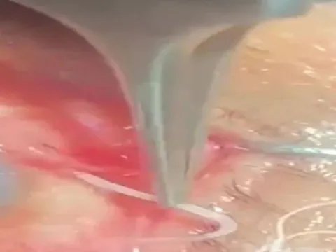 Người đàn ông 60 tuổi đau nhói ở mắt, bác sĩ sốc nặng khi phát hiện "thứ đáng sợ" bên trong